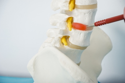 model of spine with herniated disc